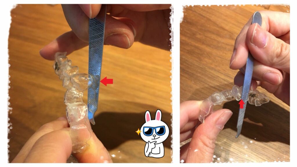 戴隱適美不舒服的解決方法ㄧ：用酒精消毒過的指甲刀稍微磨一下透明牙套上不是很平順的地方