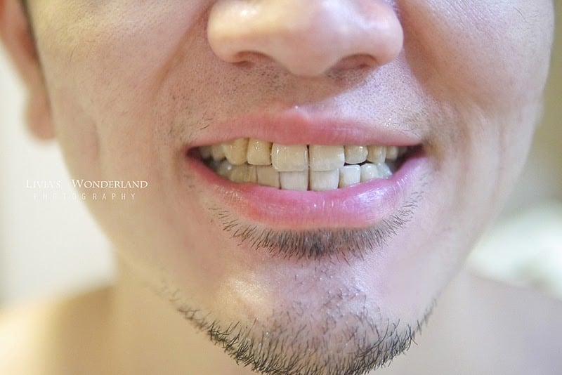 隱適美隱形牙套日記-invisalign-戴蒙矯正器-牙齒矯正心得比較-隱適美療程一年多後牙齒排列非常整齊