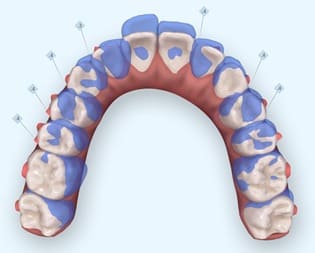 暴牙矯正案例-隱適美隱形矯正針對暴牙做的上前牙後退的設計