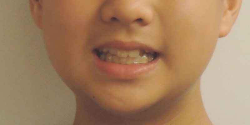 青少年隱適美-隱形矯正-牙齒縫隙大-反咬-高位犬齒-牙齒矯正臉型-矯正前-正面