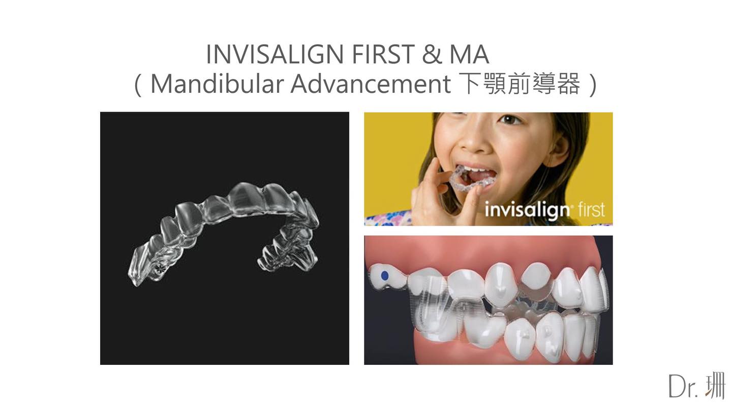 invisalign-first-MA下顎前導器-兒童隱適美-台中-兒童牙齒矯正-隱適美-Dr.珊