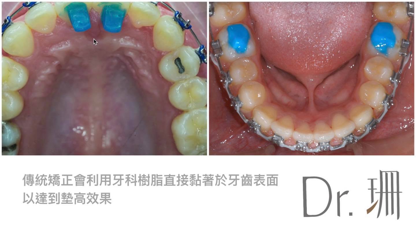 傳統牙齒矯正-樹脂咬合墊高-台中-牙齒矯正-隱適美-Dr.珊