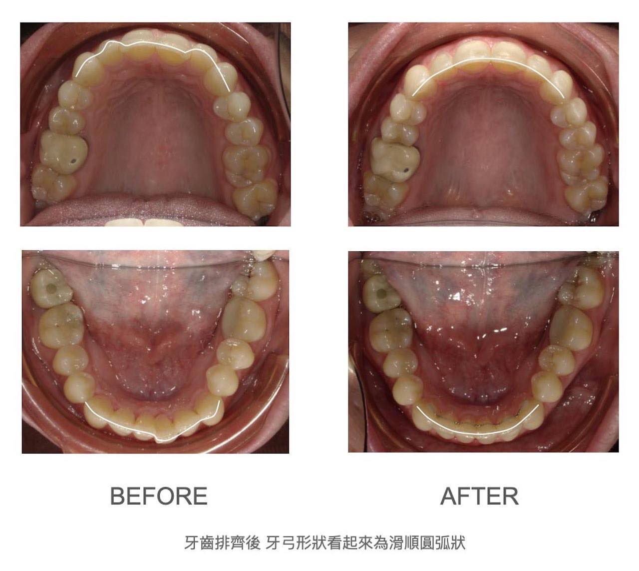 隱適美Lite輕矯正前後上下排牙弓形狀變化，牙齒排齊後牙弓形狀更滑順