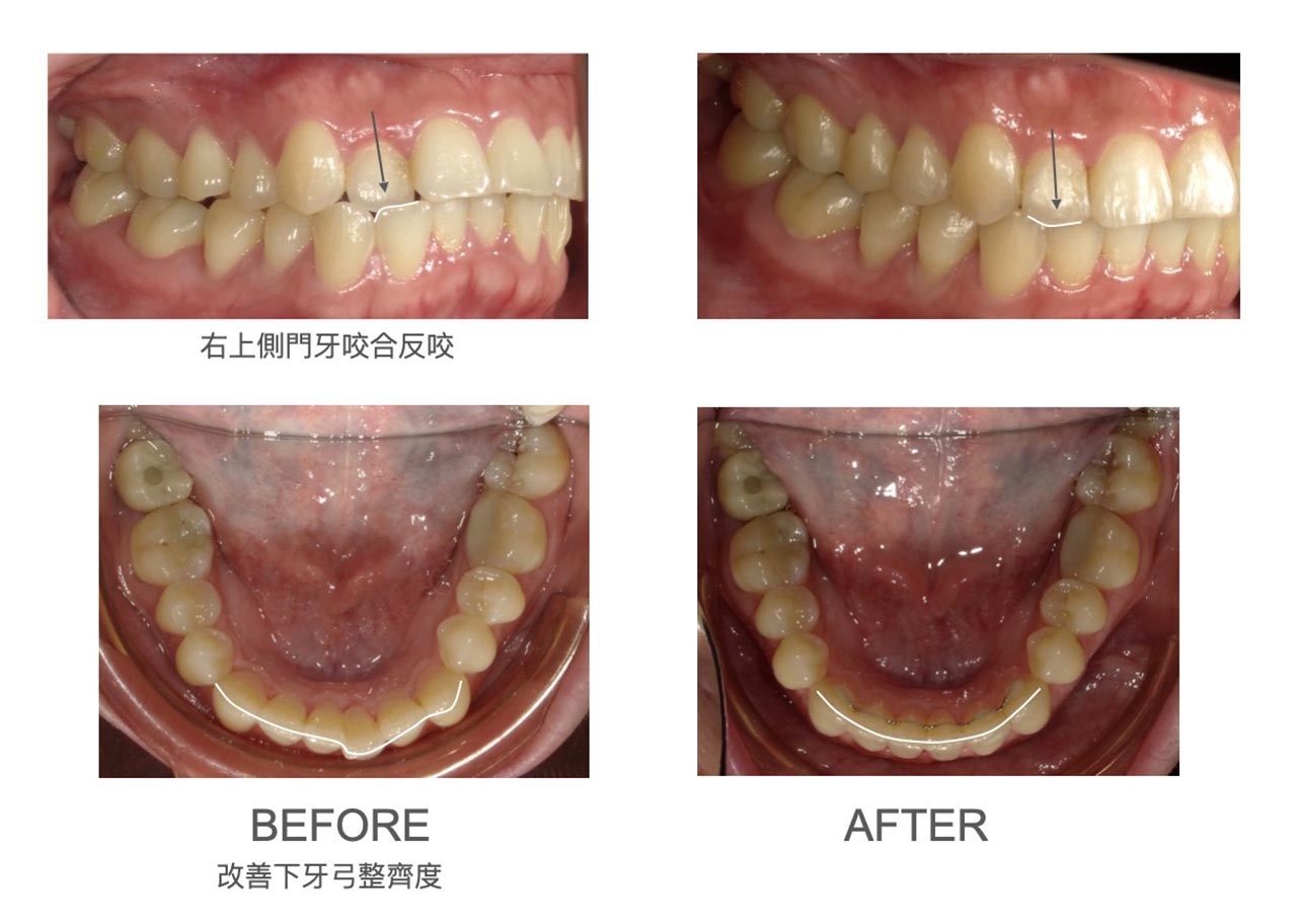 隱適美Lite輕矯正前後咬合與牙弓形狀變化，改善側門牙反咬與下牙弓整齊度