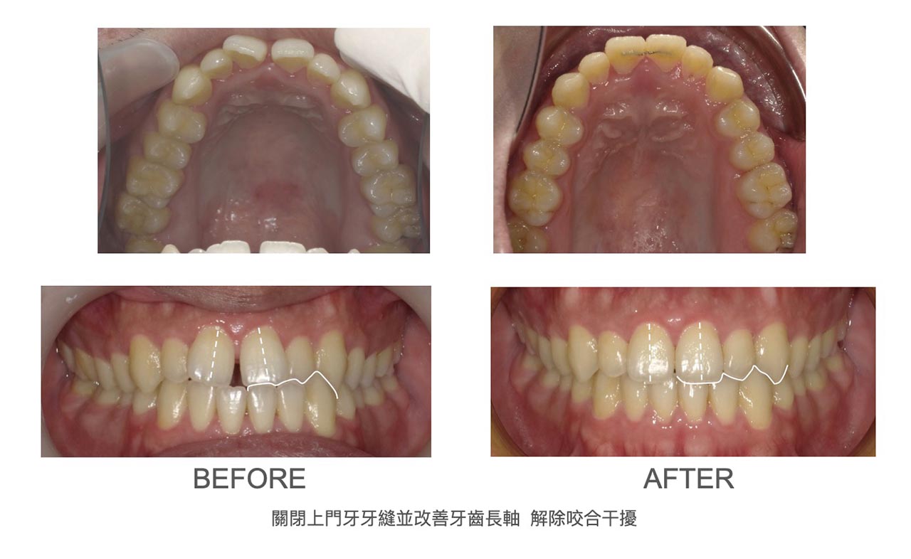 隱適美Lite輕矯正前後牙弓形狀與牙齒咬合變化，關閉上門牙牙縫並改善牙齒長軸，解除咬合干擾