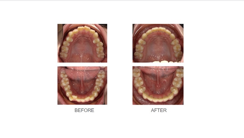 隱適美暴牙矯正前後上下排牙弓形狀變化：矯正前牙齒較突出且些微凌亂；拔牙矯正後排齊牙齒，牙弓形狀更圓滑