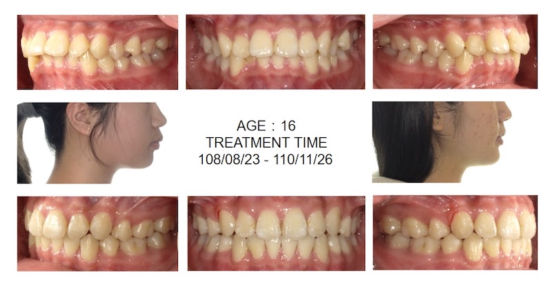 隱適美暴牙矯正前後臉型及咬合變化，改善嘴凸、齒列也變得整齊許多