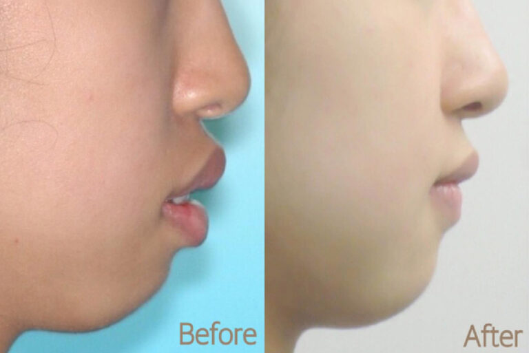 隱適美拔牙-矯正拔牙-楊念珊醫師