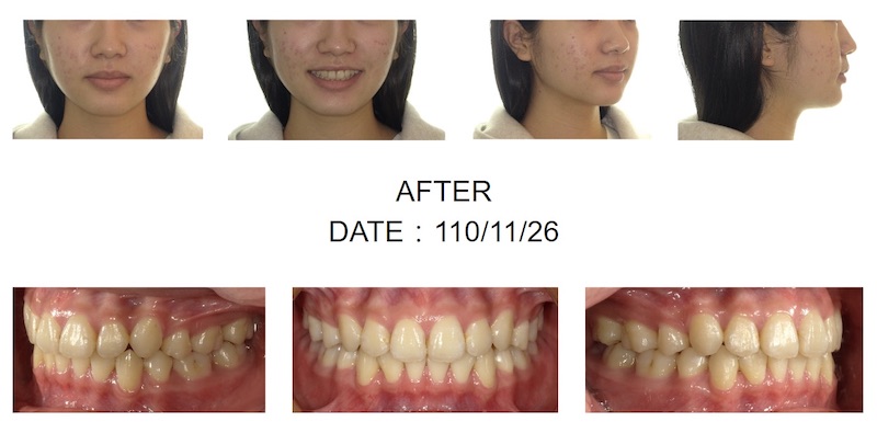 隱適美暴牙矯正後的各角度臉型及咬合近照，門牙內縮排齊也改善側面臉型輪廓