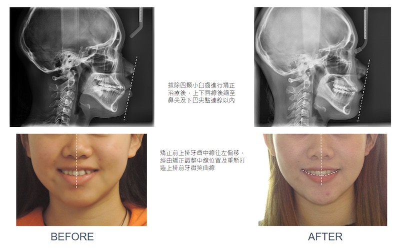 隱適美矯正前後側面臉型X光與牙齒中線變化：拔四顆小臼齒矯正後，上下唇線後退至鼻尖及下巴尖點連線以內；牙齒中線原本往左偏移，矯正後重新打造上排前牙微笑曲線