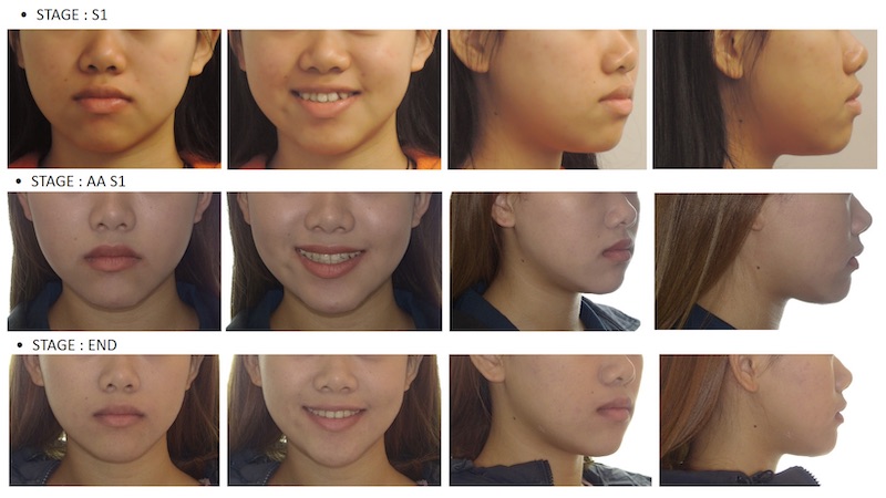 隱適美矯正過程的臉型外觀變化紀錄：原本牙齒亂、中線偏移、側臉輪廓嘴巴較凸；拔小臼齒矯正後改善微笑曲線、嘴唇後退，臉型輪廓變得更漂亮
