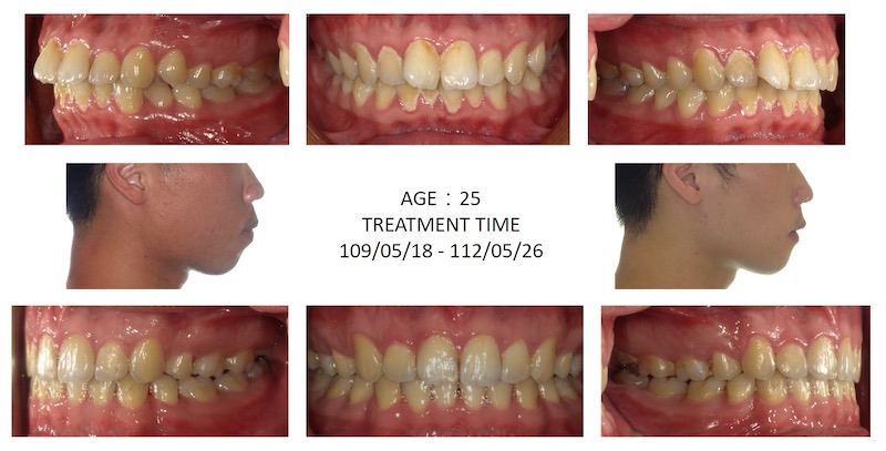 隱適美暴牙矯正前後臉型及咬合變化比較，牙齒內縮變整齊，也改善臉型輪廓