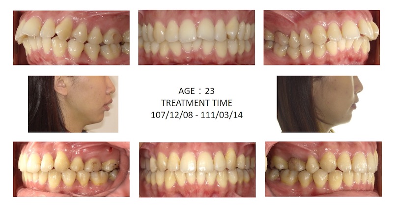 隱適美骨暴矯正前後臉型及咬合變化比較，牙齒內縮排整齊，也改善側面臉型輪廓