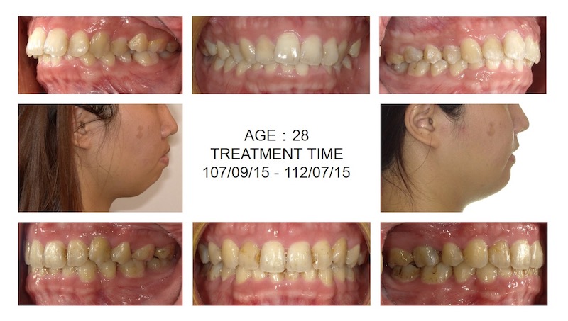 隱適美暴牙矯正前後臉型及咬合變化比較，牙齒排列整齊，也改善側面臉型輪廓