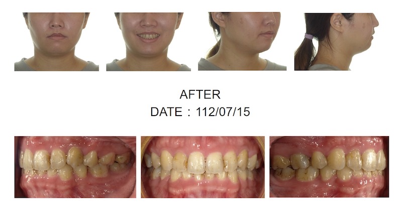 隱適美暴牙矯正後的各角度臉型及咬合近照，牙齒排整齊也改善側臉輪廓