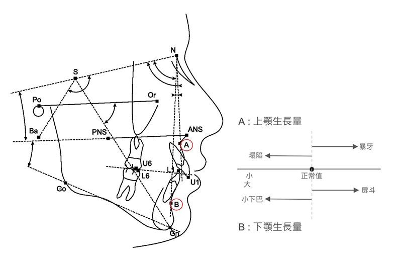 側顱X光片(Cepha)的ＡＢ測量點示意圖，定位出上顎骨和下顎骨過多的量