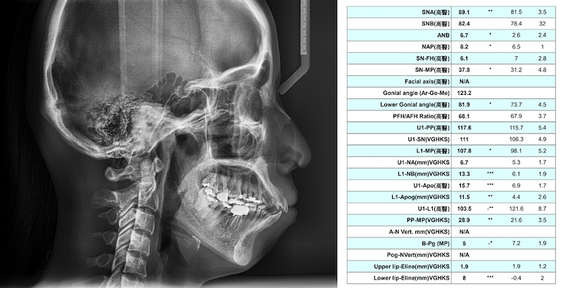 骨性暴牙側顱X光片與數值分析表