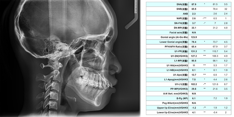 齒性暴牙側顱X光片與數值分析表