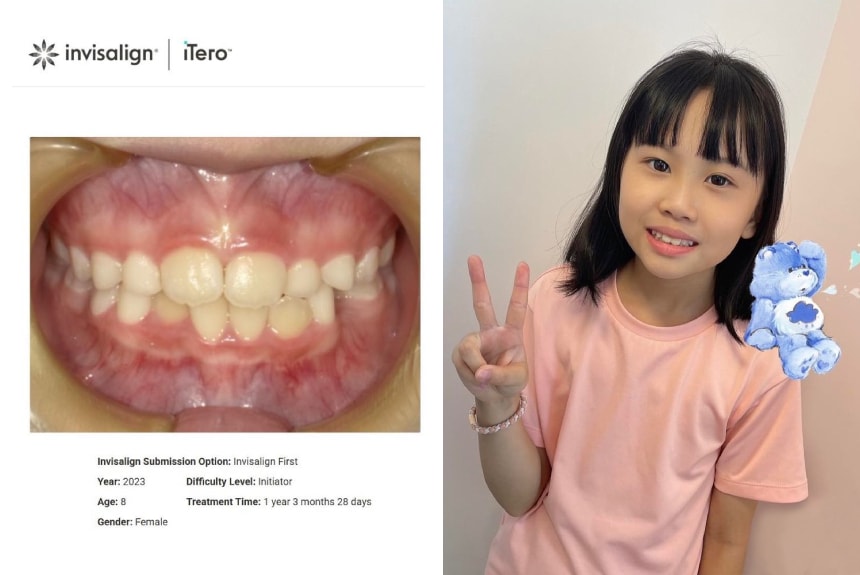 幾歲矯正牙齒比較好-兒童隱適美-隱適美first-台中-推薦-楊念珊醫師-1