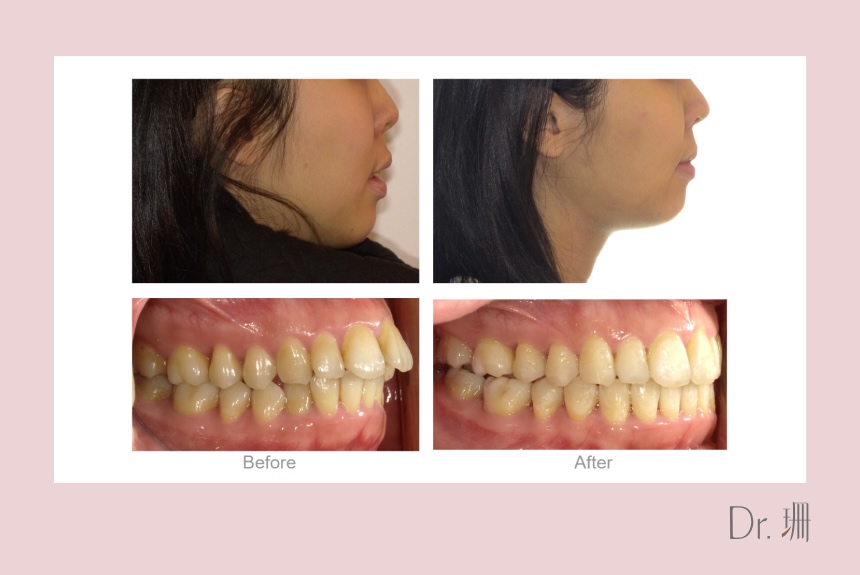 暴牙矯正-拔牙-正顎手術-隱適美暴牙-台中-隱適美-推薦-楊念珊醫師