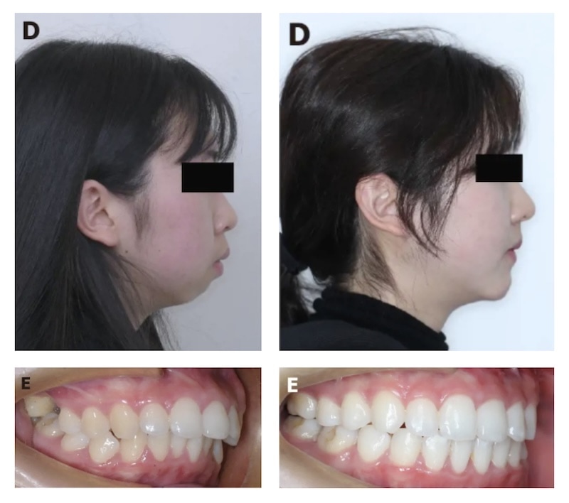嚴重骨性暴牙患者採正顎手術前後對比,改善前牙突出與下巴後縮問題,臉型整體更立體自然