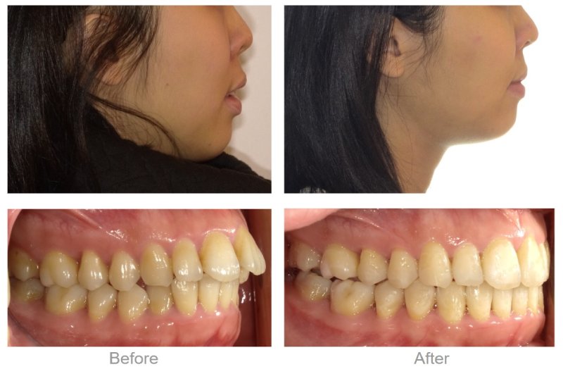 齒性暴牙矯正前後照片,利用拔智齒空間讓前牙內收,臉型線條明顯變順