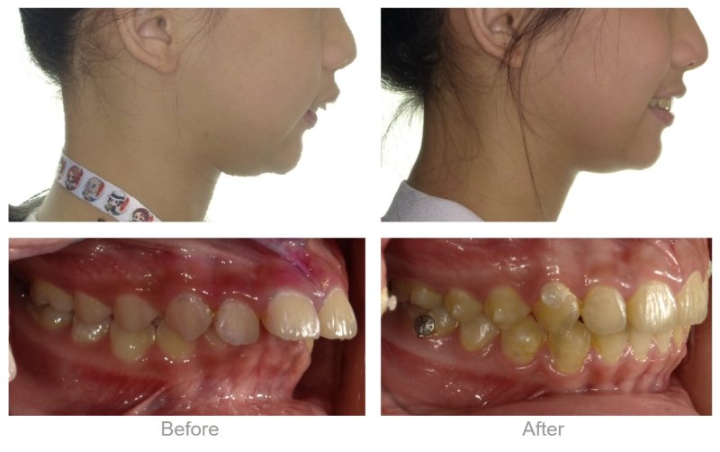 假骨性真齒性暴牙矯正前,上顎突出嘴唇無法自然閉合,透過擴弓矯正後改善咬合關係,下巴明顯前移