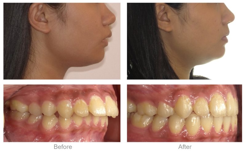 上顎骨性＋齒性暴牙，透過拔牙矯正大量後退內縮，改善暴牙與嘴唇突出，臉部輪廓更平順