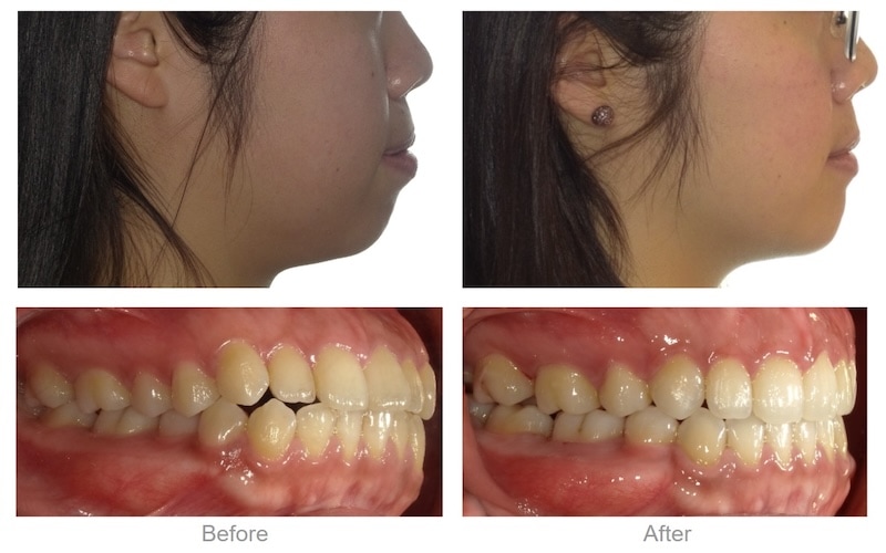 骨性伴隨輕微齒性暴牙，上排前牙角度微微向前飛，透過隱適美細緻的力學設計將牙冠與牙根一併平移收進來，臉型變自然柔和