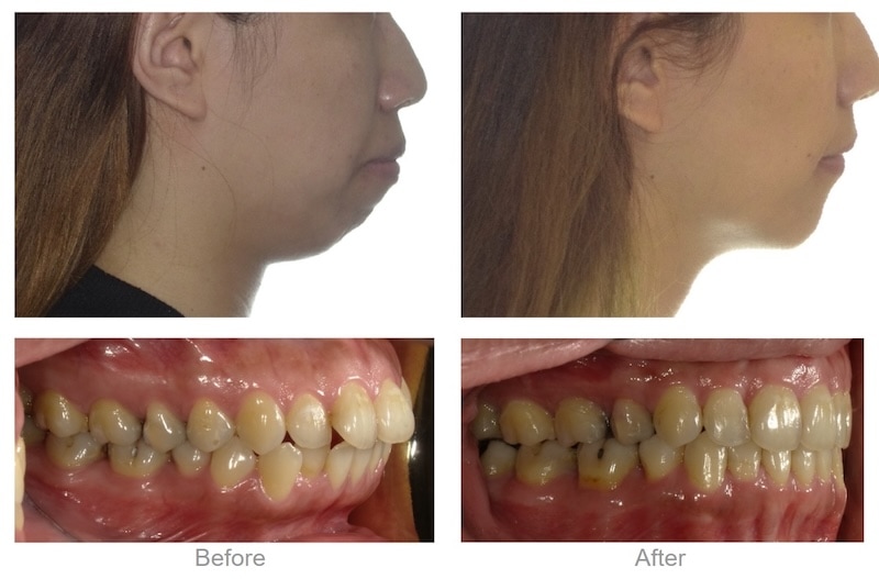 骨性＋齒性暴牙透過拔牙與骨釘矯正前後對比，下巴逆時針旋轉變得更加明顯且立體