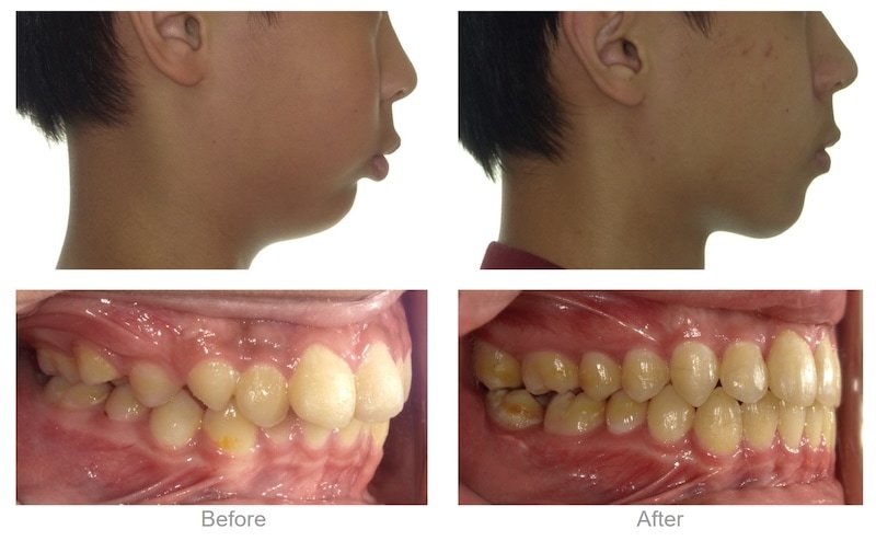 小下巴假性暴牙案例,透過隱適美MA下顎前導矯正後改善下巴後縮與暴牙,臉型比例更和諧
