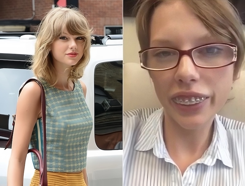 泰勒絲暴牙矯正前後外觀對比