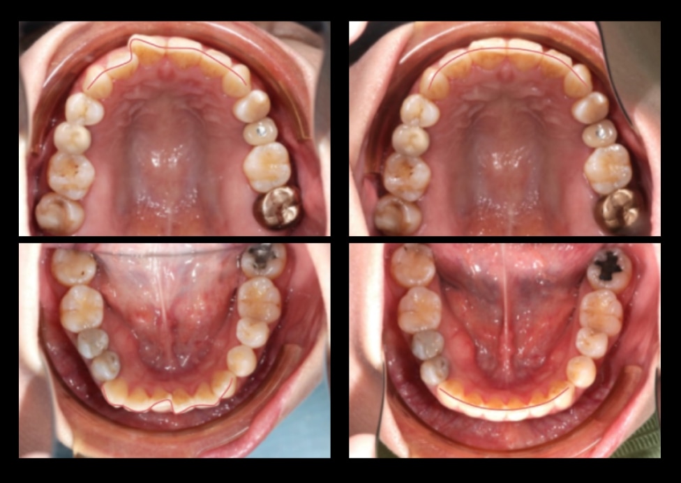 隱適美Lite矯正前後上下牙弓變化，前牙弧度從凌亂轉為圓滑U型牙弓