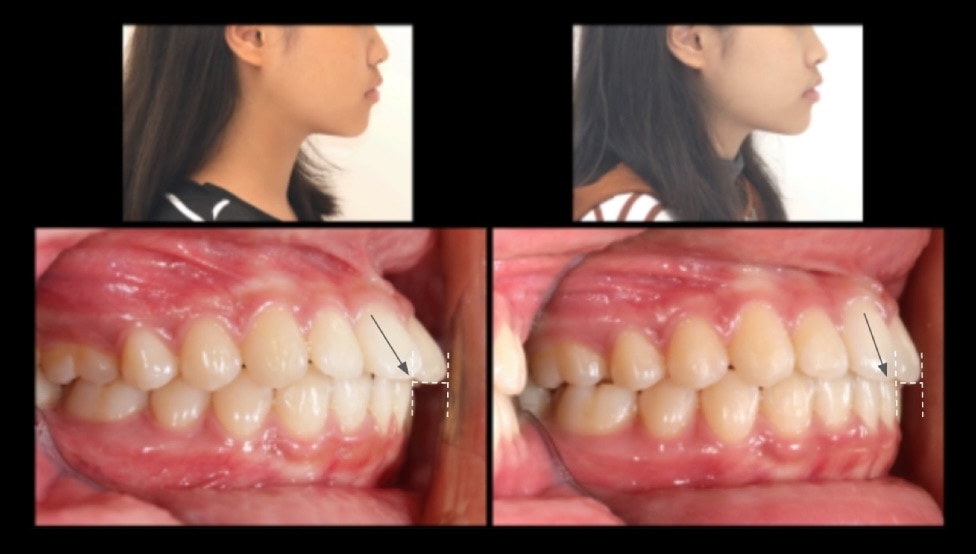 牙齒矯正前後側臉與側面咬合變化對比，拉直前牙角度並收攏下排凸出犬齒