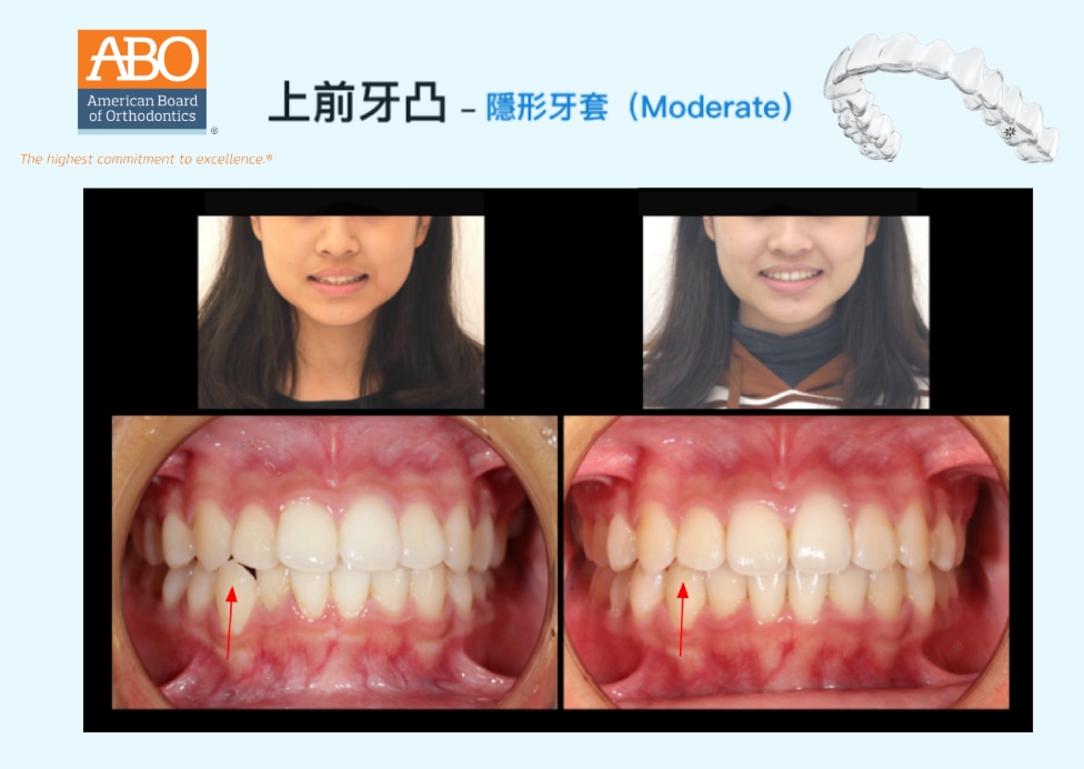 上前牙凸採隱適美矯正前後臉型及正面咬合變化對比，改善前牙突出與排列角度