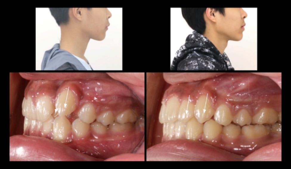 不拔牙矯正前後側臉與側面咬合變化對比，改善上側門牙與高位犬齒排列