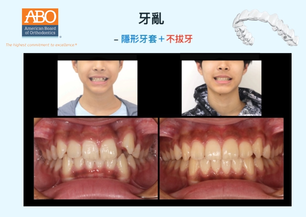 牙齒擁擠採不拔牙矯正，前後臉型與咬合對比顯示排列與美觀同步改善