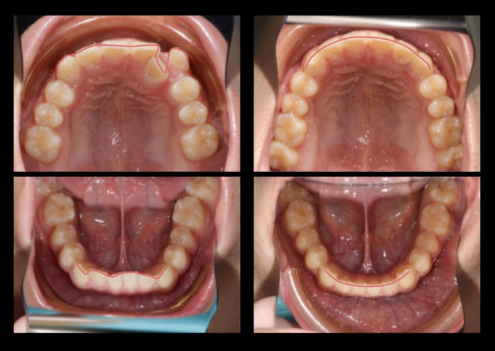 不拔牙矯正前後上下牙弓變化，排齊牙齒，牙弓形狀更圓滑