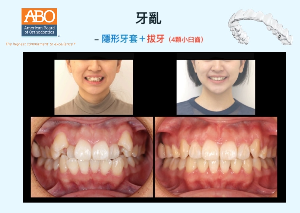 牙齒凌亂採拔牙矯正前後臉型與咬合變化對比，改善牙齒亂、高犬齒與中線偏移等問題