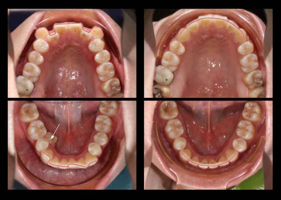 拔牙矯正前後上下牙弓變化，解決上排高犬齒與右下牙齒內縮，牙弓排列整齊