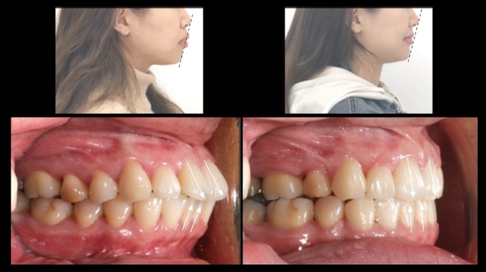 拔牙矯正前後側臉與側面咬合變化，前牙後退改善嘴唇凸，臉型更協調自然