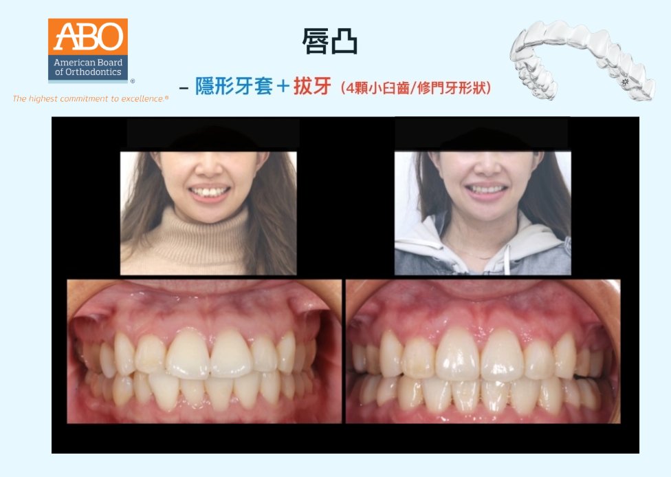 採拔牙矯正與牙齒形狀修整前後對比，改善嘴唇凸、牙齒凌亂，門牙形狀比例更加協調