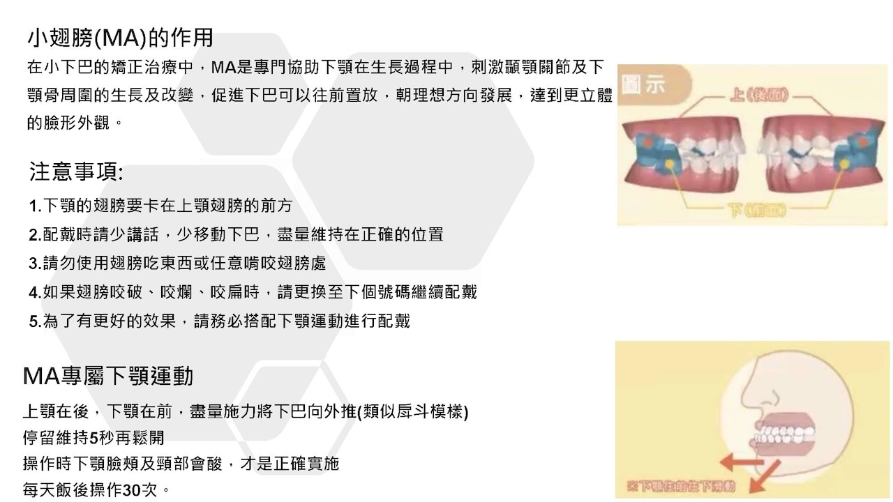 隱適美隱形牙套叮嚀小卡 - 小翅膀MA的作用