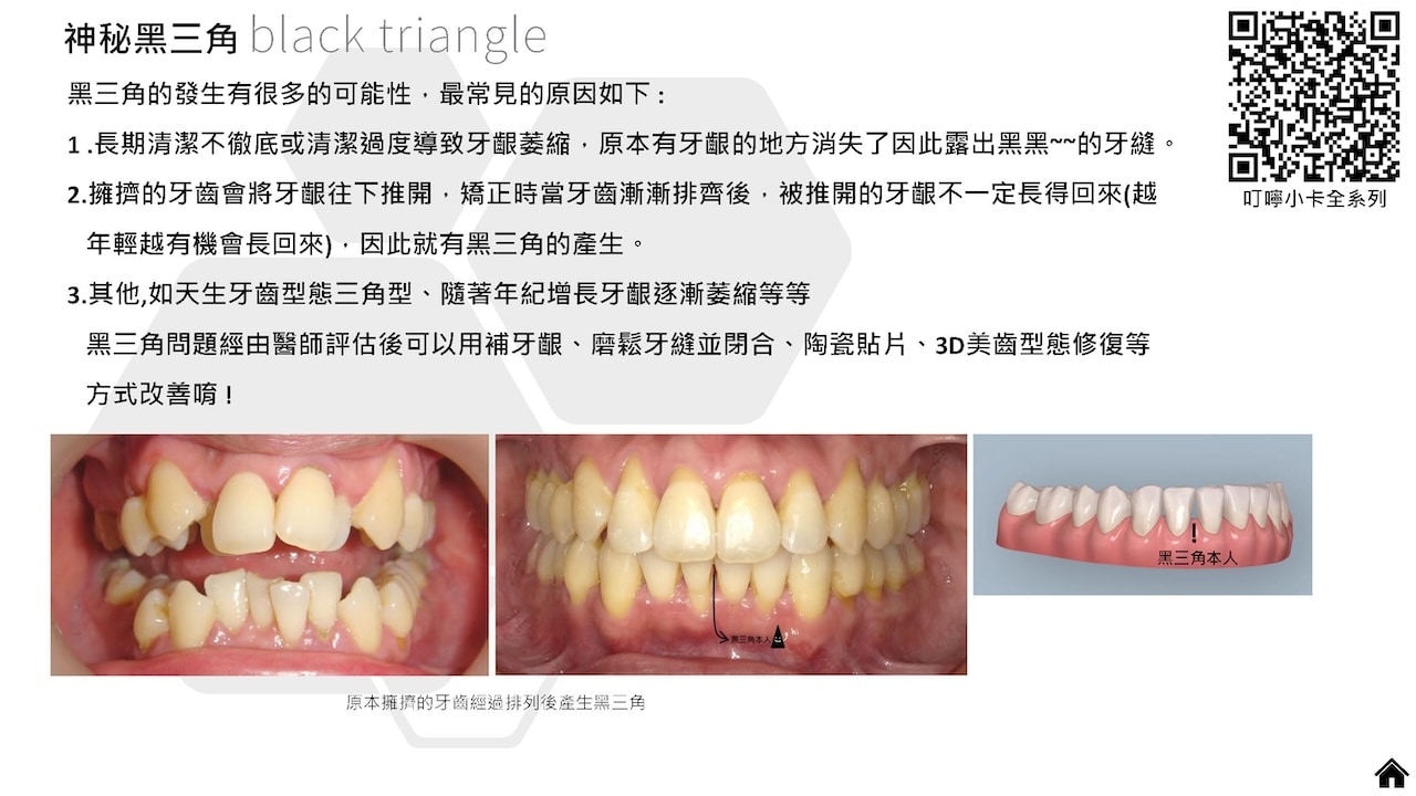 隱適美隱形牙套叮嚀小卡 - 神秘黑三角