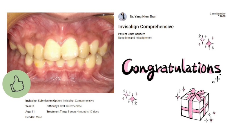 入選 Invisalign 全球精選案例：顯示11歲青少年患者主要問題為深咬與齒列不整