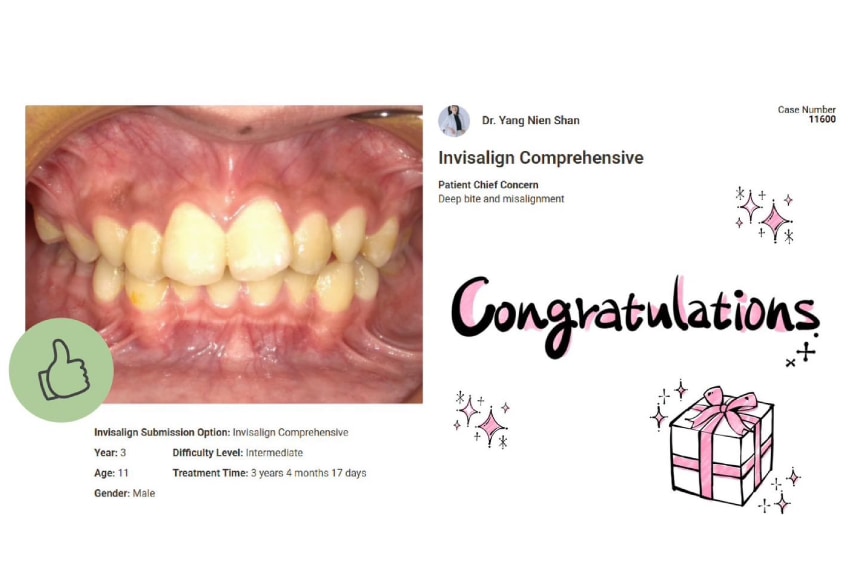 青少年-隱適美-MA-小下巴-深咬-隱形矯正-台中-推薦-楊念珊醫師