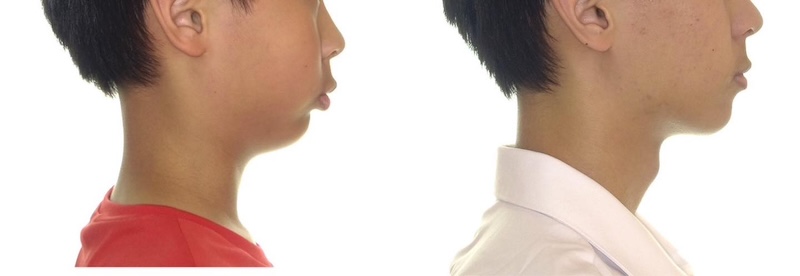 青少年隱適美矯正前後側臉對比，展現下巴發育與臉型線條的改善