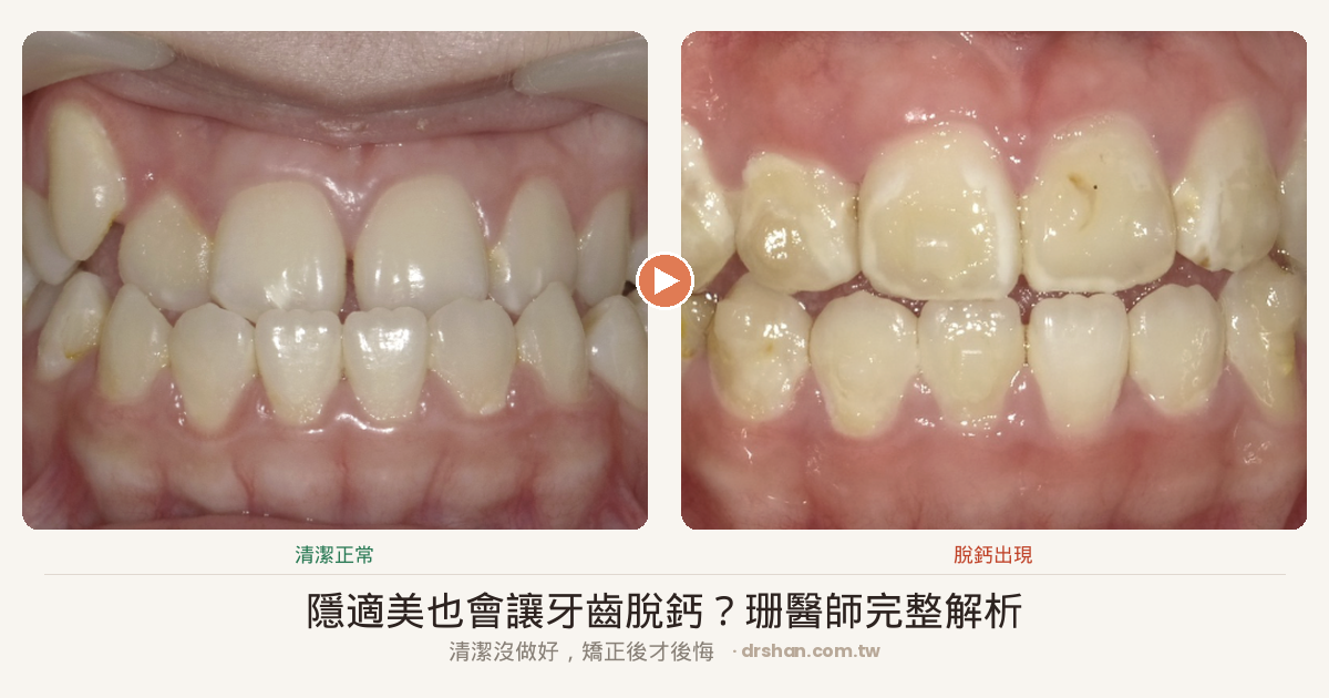 隱適美脫鈣對比圖：正常牙齒（左）與脫鈣白斑牙齒（右）